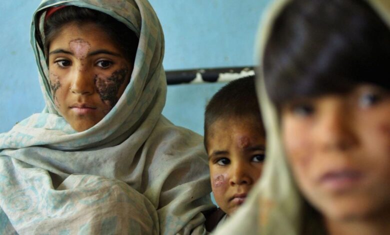 Leishmaniasis Leishmaniasis